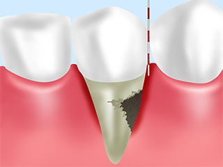 歯周精密検査