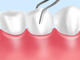 歯の動揺度検査