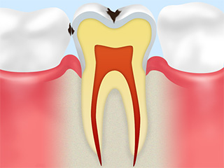 C1 初期のむし歯