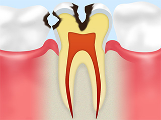 C2 中期のむし歯