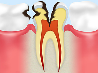 C3 後期のむし歯