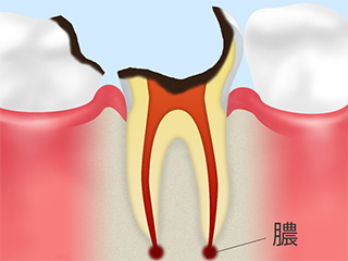 C4 末期のむし歯